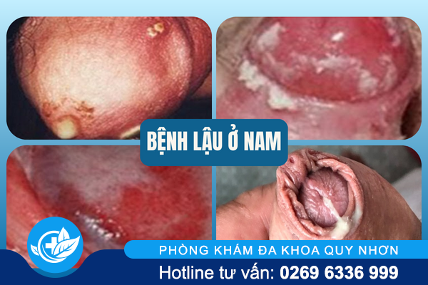 cach-chua-lau-o-nam-hieu-qua-1