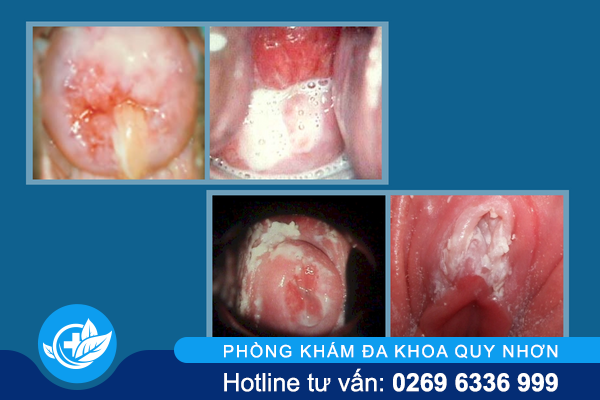 am-dao-chay-mu-can-trong-voi-benh-lau-1