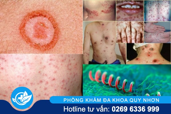 anh-benh-giang-mai-qua-cac-giai-doan