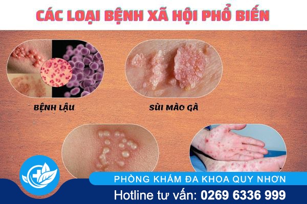 xét nghiệm mụn rộp sinh dục - 2