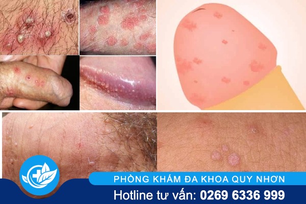 dau-duong-vat-noi-mun-do-nguyen-nhan