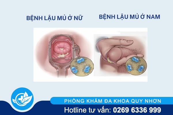 dau-hieu-benh-lau-mu