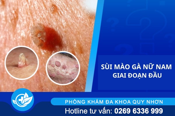 sui-mao-ga-nu-nam-giai-doan-dau