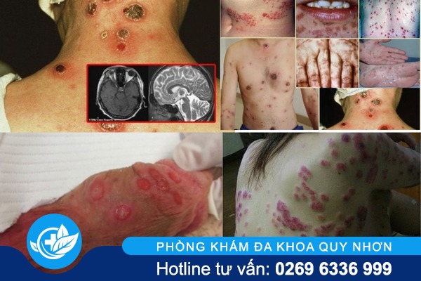 trieu-chung-benh-giang-mai-nang