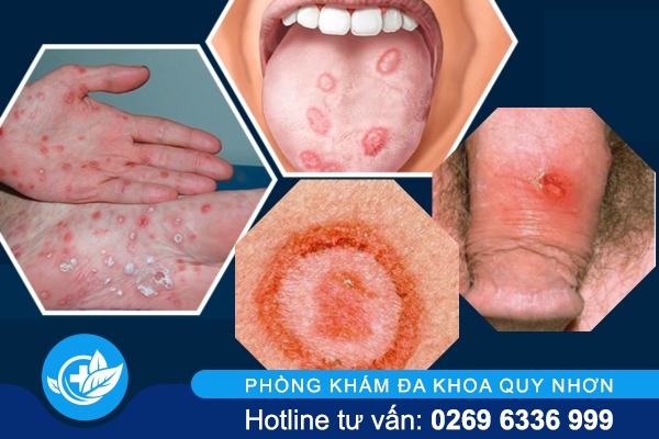 trieu-chung-benh-giang-mai