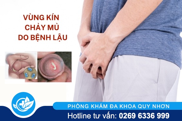 vung-kin-chay-mu-do-benh-lau