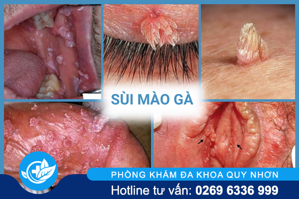 thong-tin-nen-biet-ve-benh-xa-hoi-o-nam-va-nu-1-1