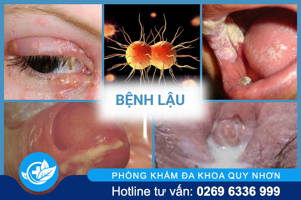 thong-tin-nen-biet-ve-benh-xa-hoi-o-nam-va-nu-5-1