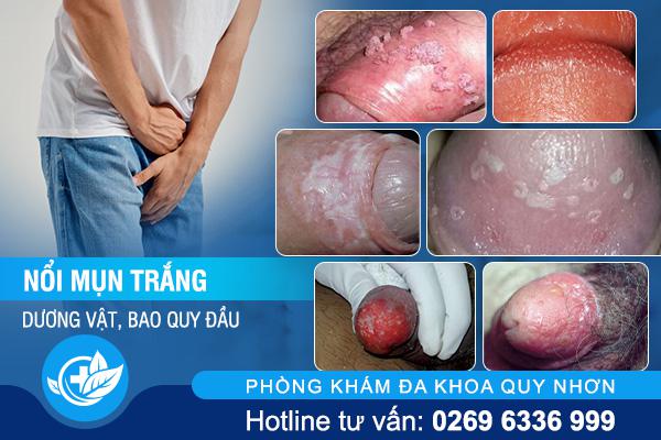 hinh-minh-hoa-noi-mun-trang