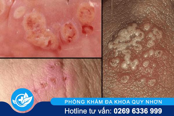 bien-chung-benh-lau (1)