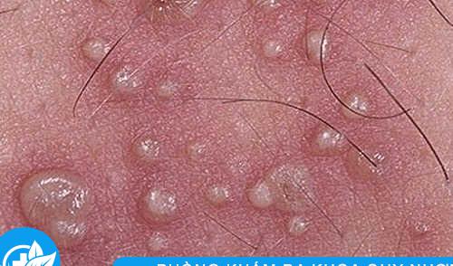 mụn mủ vùng kín