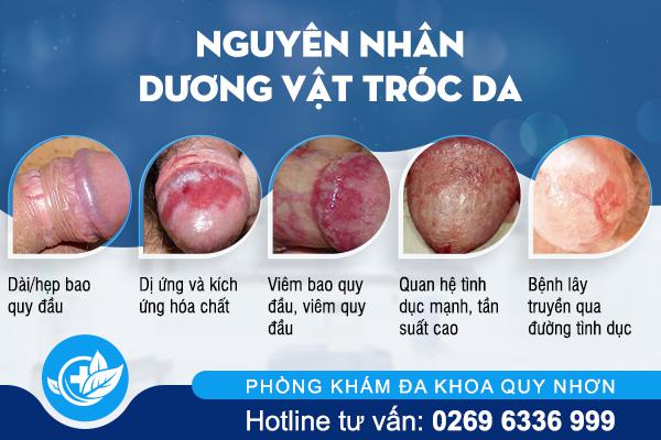 nguyen-nhan-duong-vat-troc-da