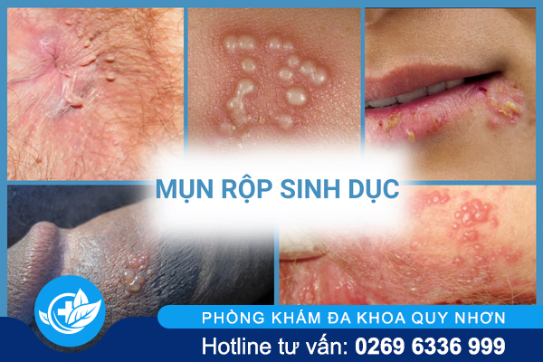 thong-tin-nen-biet-ve-benh-xa-hoi-o-nam-va-nu-3-1