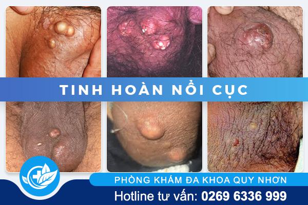 tinh-hoan-noi-cuc