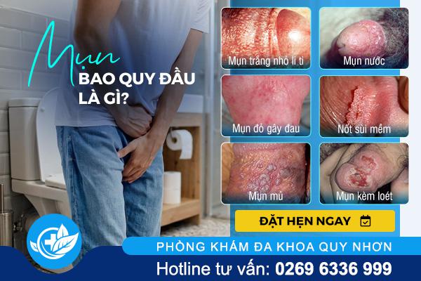 mun-bao-quy-dau-la-gi