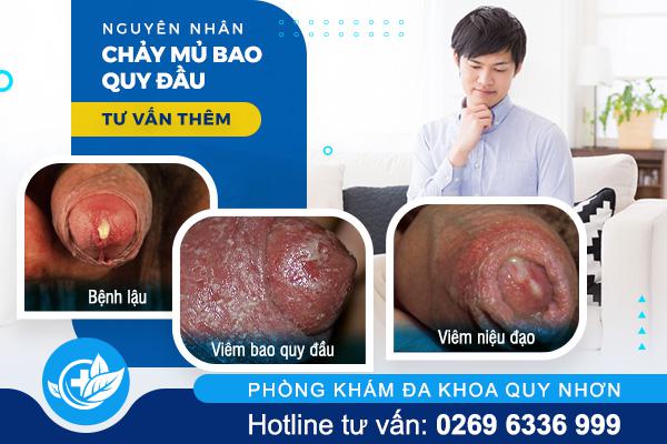 nguyen-nhan-chay-mu-bao-quy-dau