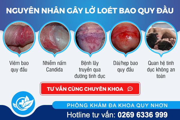 nguyen-nhan-lo-loet-bao-quy-dau