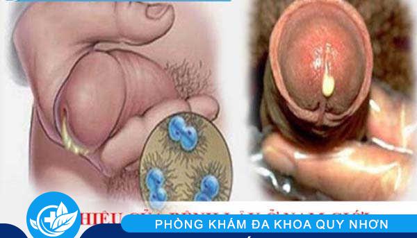 hình ảnh lậu ở nam giới