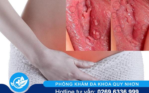 sùi mào gà âm đạo