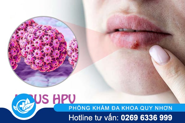 Chữa sùi mào gà ở miệng bằng phương pháp nào hiệu quả?