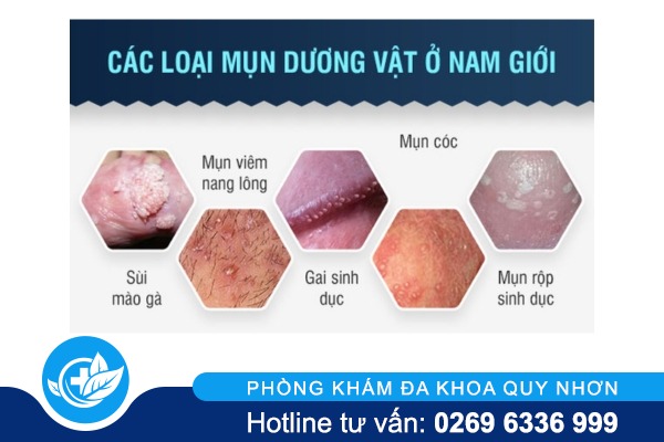 mun-tren-duong-vat-nam