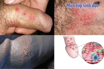 Nổi mụn trên dương vật là bị bệnh gì?