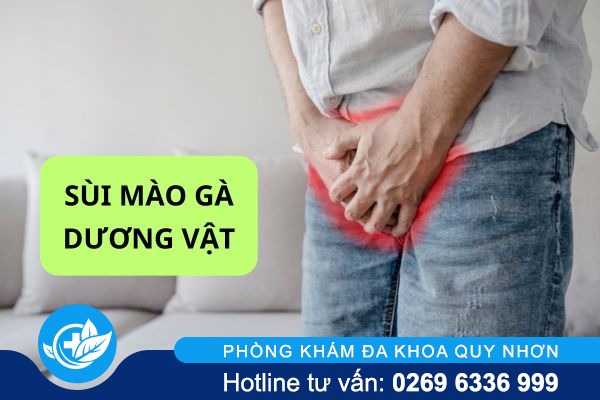 Những thông tin quan trọng về sùi mào gà dương vật 