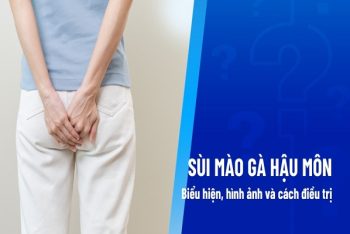 Sùi mào gà hậu môn nguy hiểm khôn lường nhưng ít ai biết