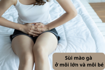 Thông tin về sùi mào gà ở môi lớn và môi bé