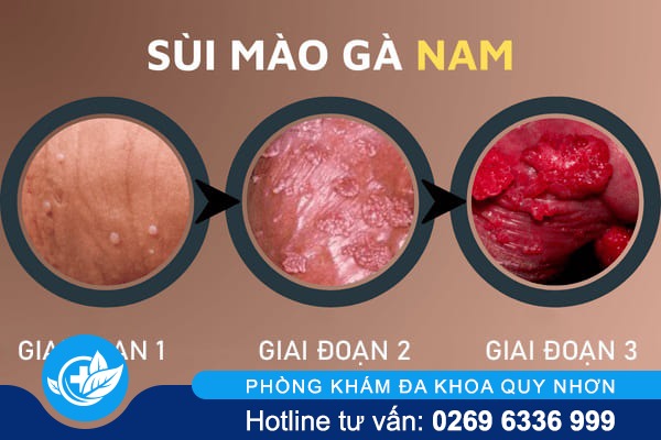 giai-doan-sui-maoo-ga-o-nam