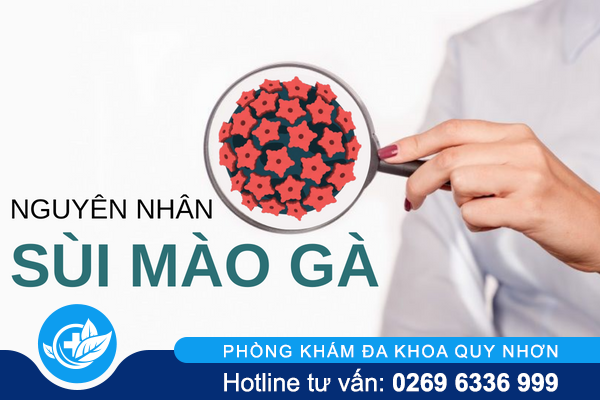 3+ Nguyên nhân sùi mào gà không ngờ đến 