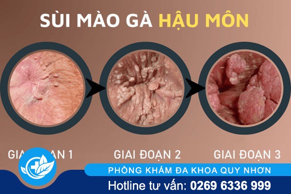 bieu-hien-sui-mao-ga-o-hau-mon