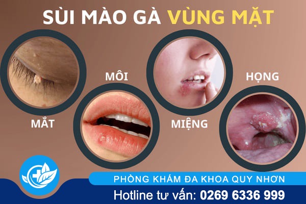 bieu-hien-sui-mao-ga-o-mieng