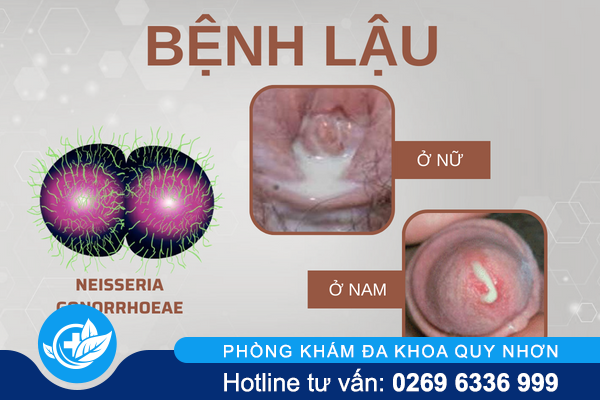 chi-phi-chua-lau-hien-nay-la-bao-nhieu-1