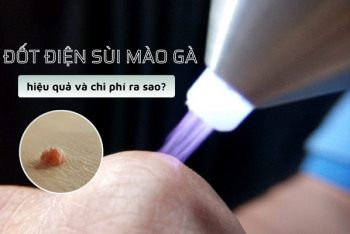 Đốt điện sùi mào gà: Hiệu quả và chi phí ra sao?