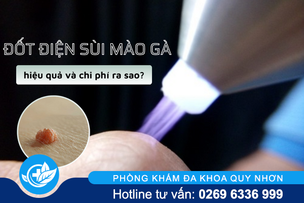Đốt điện sùi mào gà: Hiệu quả và chi phí ra sao?