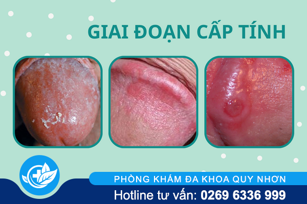 lau-duong-vat-can-benh-nguy-hiem-o-nam-gioi-2