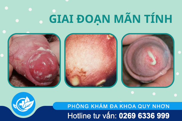 lau-duong-vat-can-benh-nguy-hiem-o-nam-gioi-3