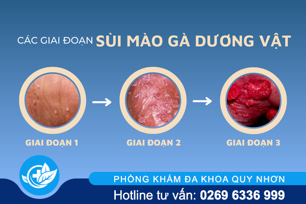 sui-mao-ga-duong-vat-kho-noi-nen-day-nguy-hiem-1