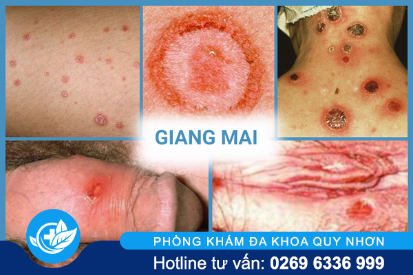 thong-tin-nen-biet-ve-benh-xa-hoi-o-nam-va-nu-2