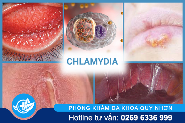 thong-tin-nen-biet-ve-benh-xa-hoi-o-nam-va-nu-4