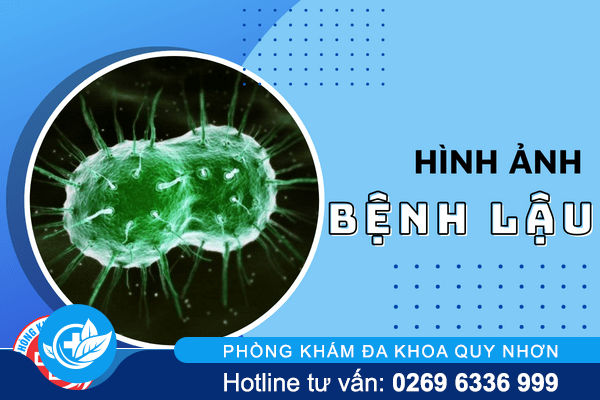 Tổng hợp hình ảnh bệnh lậu qua từng giai đoạn