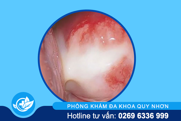 tong-hop-hinh-anh-benh-lau-qua-tung-giai-doan-5