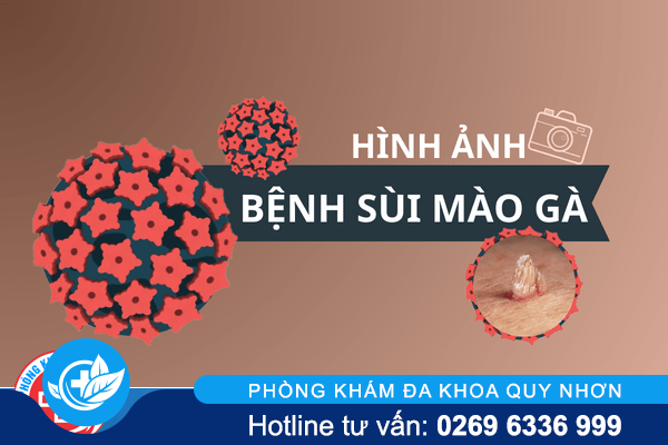 Xác định hình ảnh bệnh sùi mào gà ở các vị trí trên cơ thể