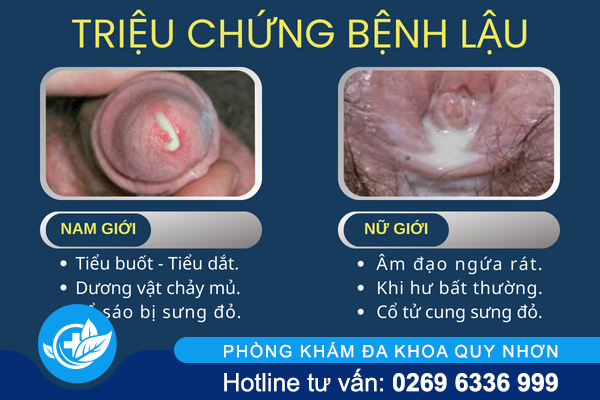 chuyen-gia-goi-y-cach-chua-benh-lau-hieu-qua-2