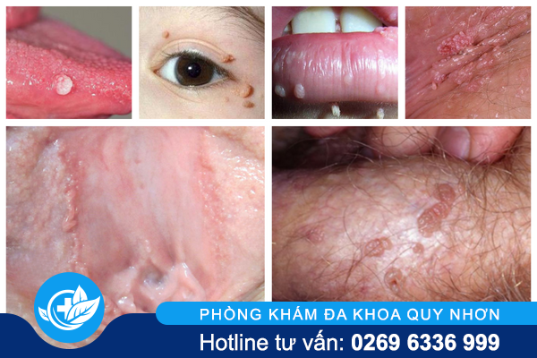 tong-hop-sui-mao-ga-dung-voi-bo-qua-1