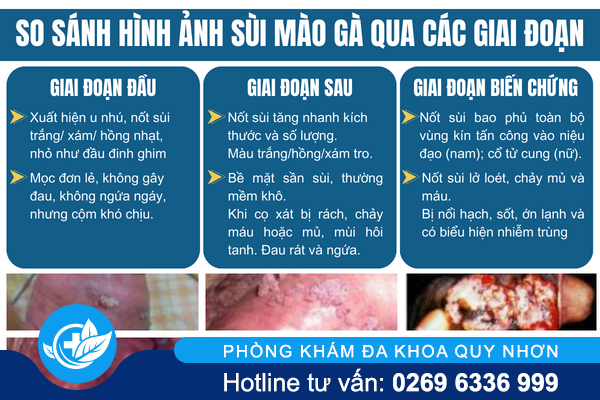 tong-hop-sui-mao-ga-dung-voi-bo-qua-2