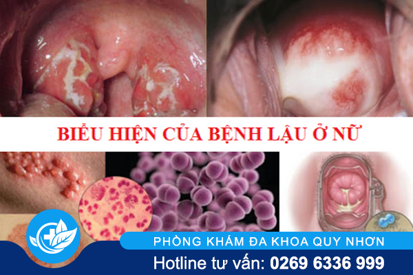 benh-lau-o-nu-gioi-trieu-chung-de-nham-lan-benh-phu-khoa-1