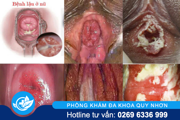 benh-lau-o-nu-gioi-trieu-chung-de-nham-lan-benh-phu-khoa-2