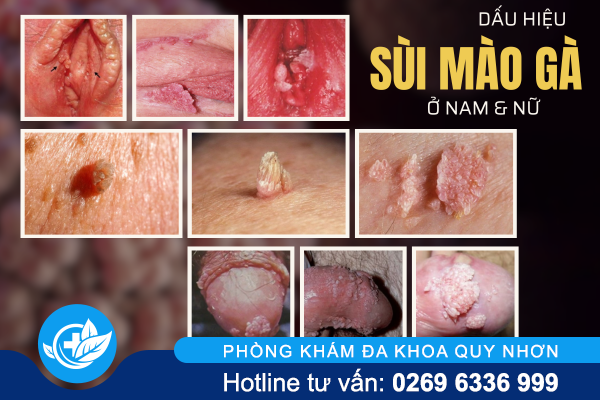 can-luu-y-voi-can-benh-sui-mao-ga-o-nam-va-nu-gioi-1